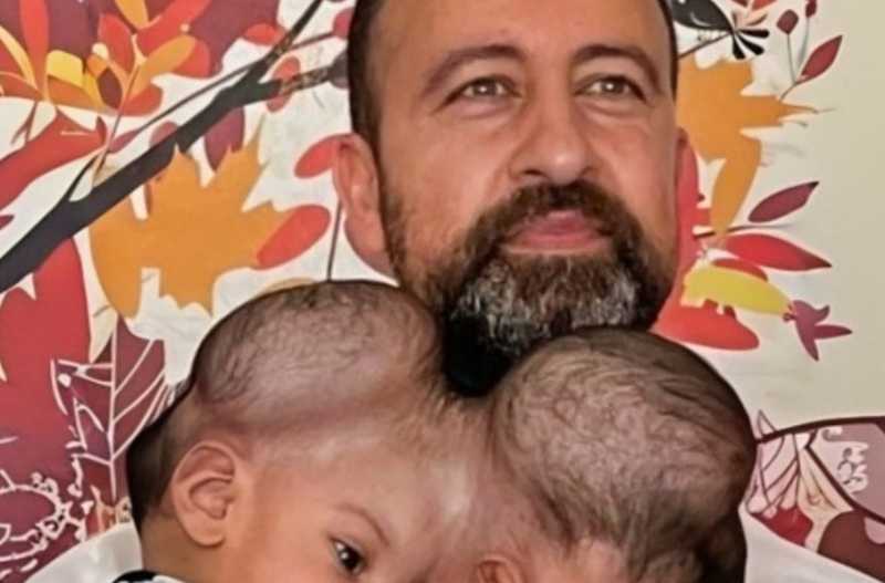 L’incredibile viaggio delle gemelline siamesi unite dal cervello: guarda il loro aspetto dopo la delicata operazione!»