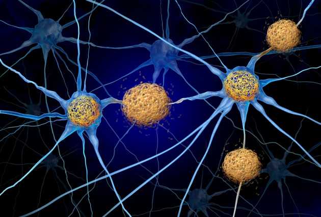 Alzheimer e difese antivirali: ipotesi, evidenze e implicazioni